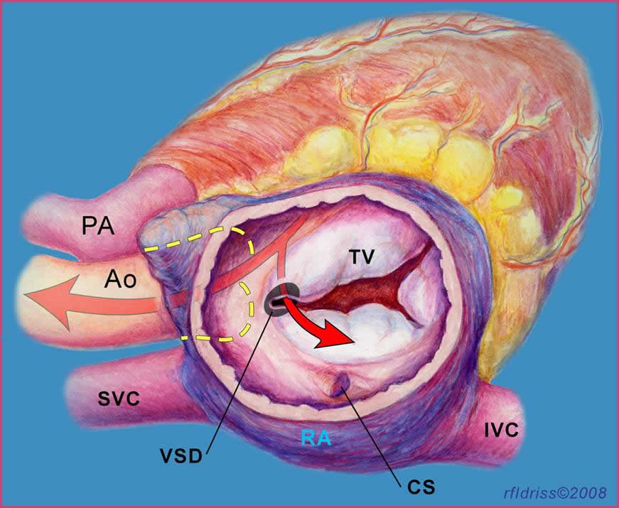 The Gerbode Defect: A Ventriculo-Atrial Defect | CTSNet