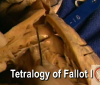 Video 4 - Tetralogy of Fallot I