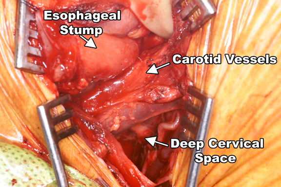 Esophagectomy with Three-Field Lymph Node Dissection | CTSNet