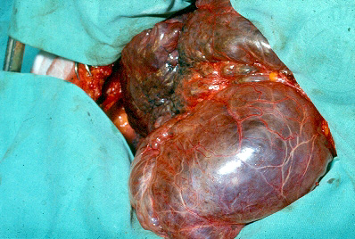 Giant Bullous Emphysema | CTSNet