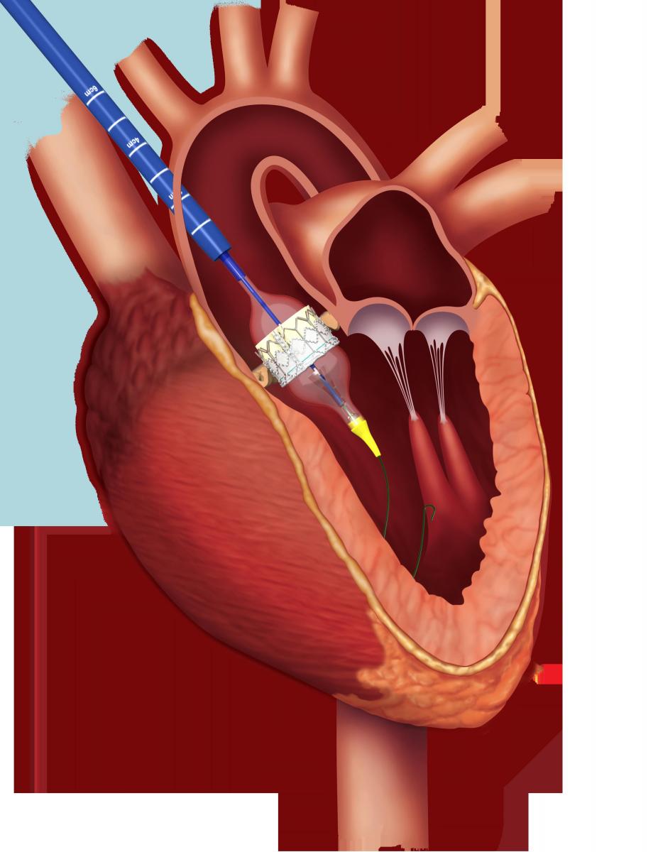 trans-aortic transcatheter aortic valve replacement with edwards