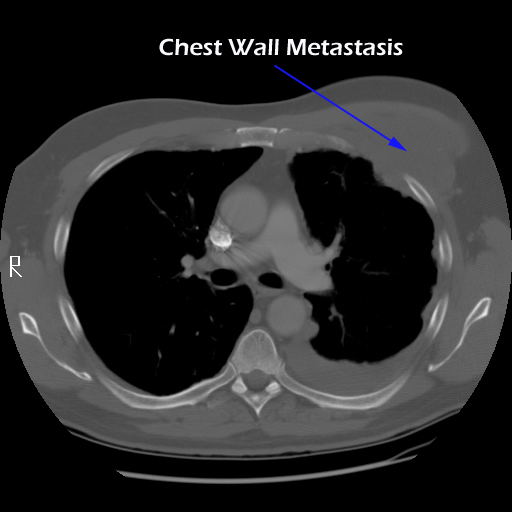 What is breast cancer with chest wall involvement?