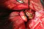 Feeding artery ligated and partially divided