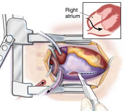 TMVR : une solution de valve cardiaque mini-invasive