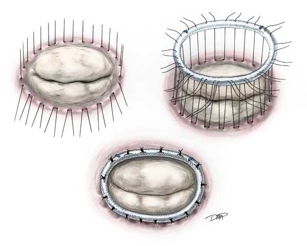 Mitral Valve Repair | CTSNet