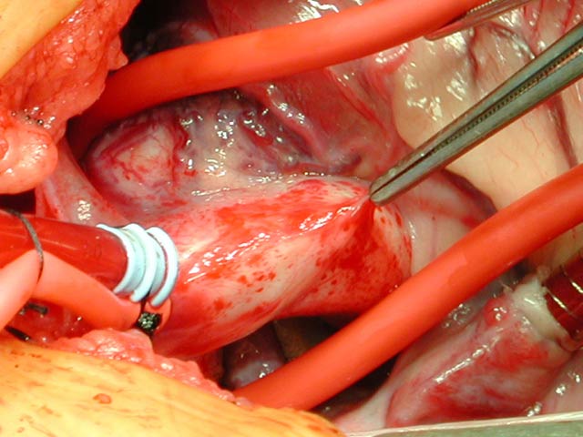 Aortic Implantation for Anomalous Origin of the Left Coronary Artery