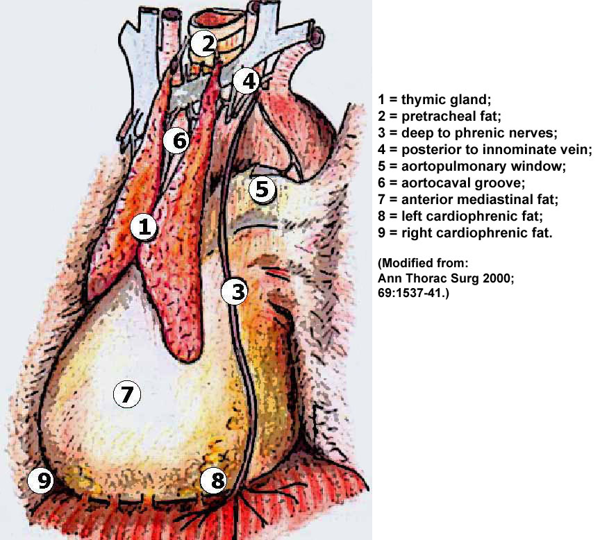 Extended VATS Thymectomy for Myasthenia Gravis Extrapleural