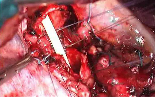 jet high frequency ventilation Resection In Options Technical And Carinal Reconstruction