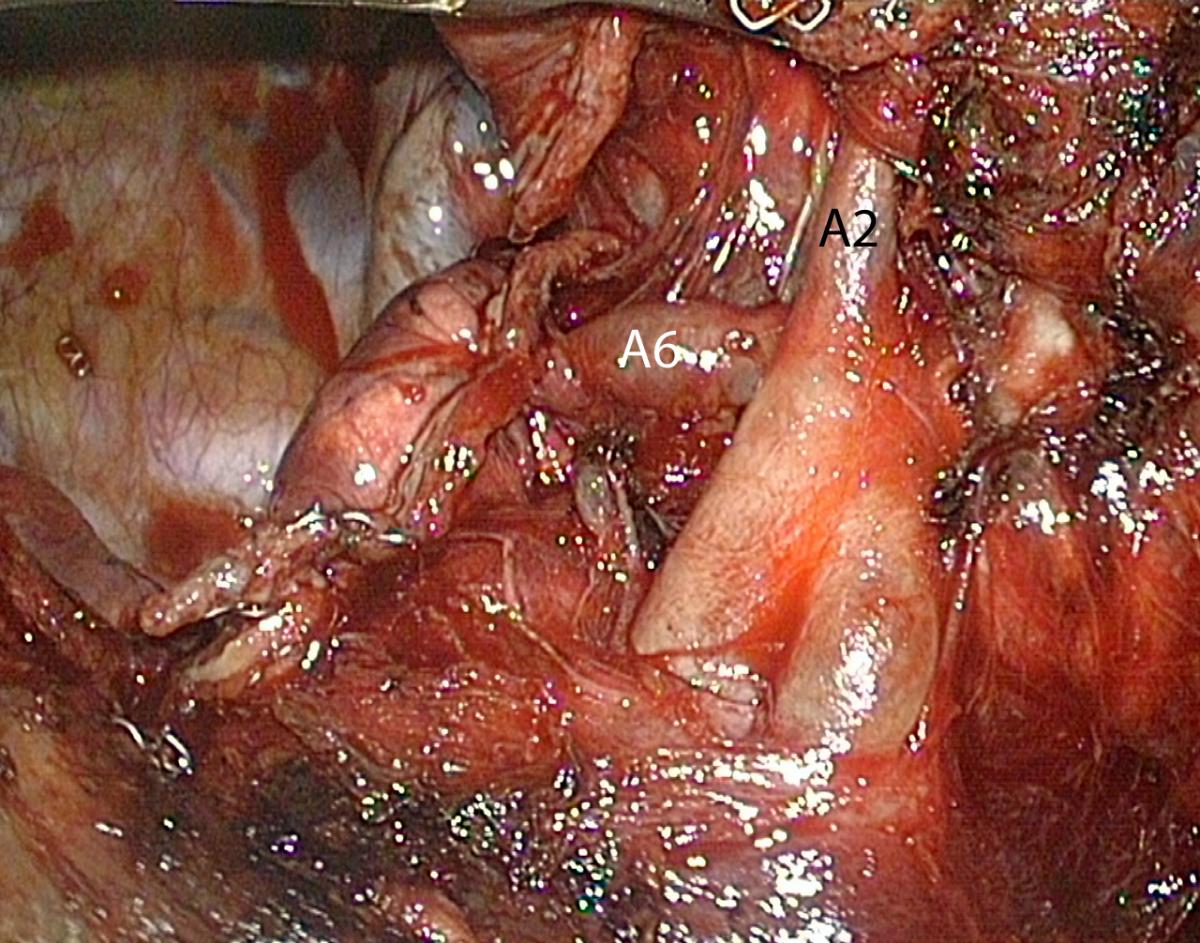 Thoracoscopic Right Upper Lobectomy Using a Full Posterior Dissection