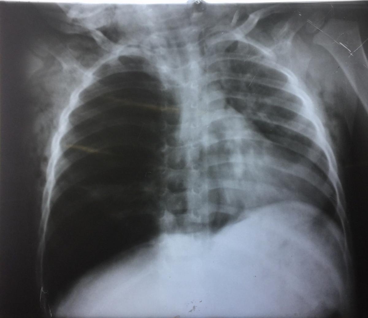 Foreign Body Inhalation in Child With Mediastinal and Subcutaneous