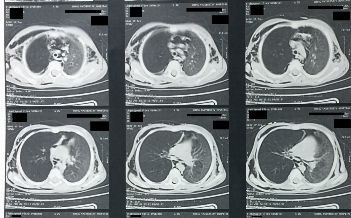 Foreign Body Inhalation in Child With Mediastinal and Subcutaneous