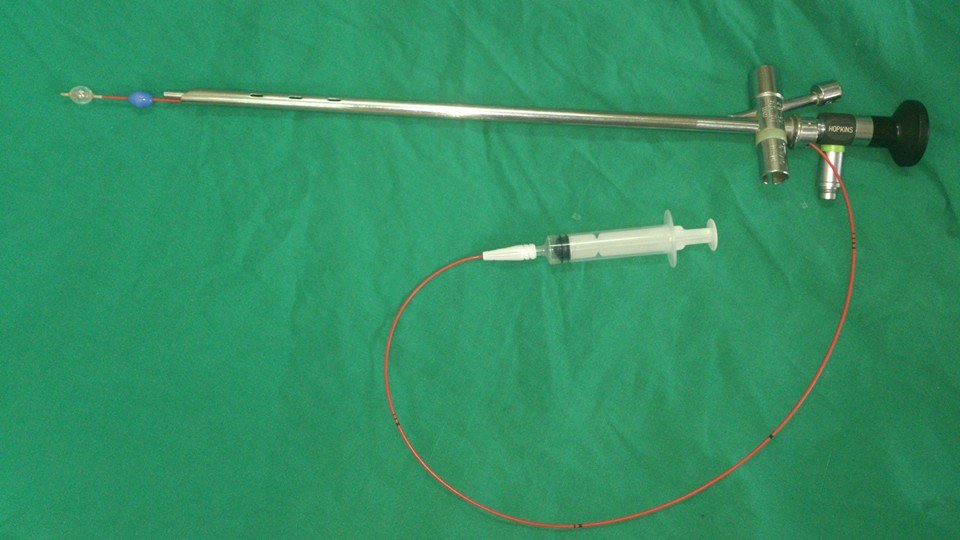 using Fogerty catheter inserting its tip inside the lumin then inflate the ballon distal to FB and gentel withdrwal of the whole bronchoscopy system with it  