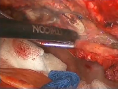 Internal Thoracic Artery Skeletonization with an Ultrasonic Scalpel