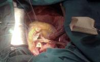 Aortic Root Reconstruction - Tirone David