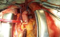 Acute Dissection A - Ascending Aorta and Arch 