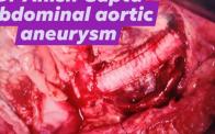 Abdominal aortic aneurysm repair-Anish Gupta