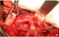 Congenital Tracheo-Oesophageal Fistula DOI: 10.21276/sasjs.2019.5.3.7