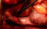 radical intercavoaortic thoracic lymphadenectomy, Paolo Macri'