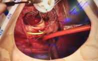 Magna Ease Mitral Valve Replacement