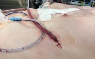 Final, Repair of Adult Pectus Excavatum