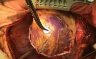 Off pump  coronary artery bypass with squeletonized mamary artery for six.  Tector Technique