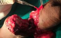 replantation surgery