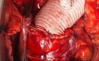 Aortic arch surgery