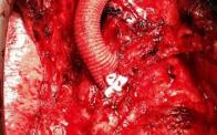 grayson wheatley hybrid arch repair aortia endovascular aneurysm dissection