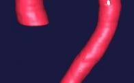 grayson wheatley aortic arch aneurysm aorta