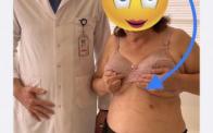 Minimally invasive CABG on woman- MICS CABG via submammary incision
