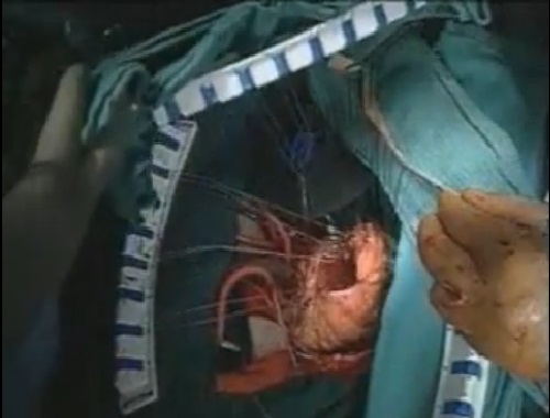 Ventricular-Restoration-for-Akinesia-Modified-Dor-Procedure-Myocardial-Protection